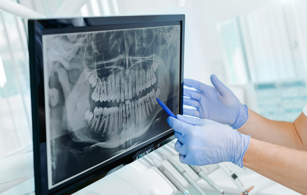 Where can I find a trusted specialist in emergency wisdom teeth extraction in Escondido