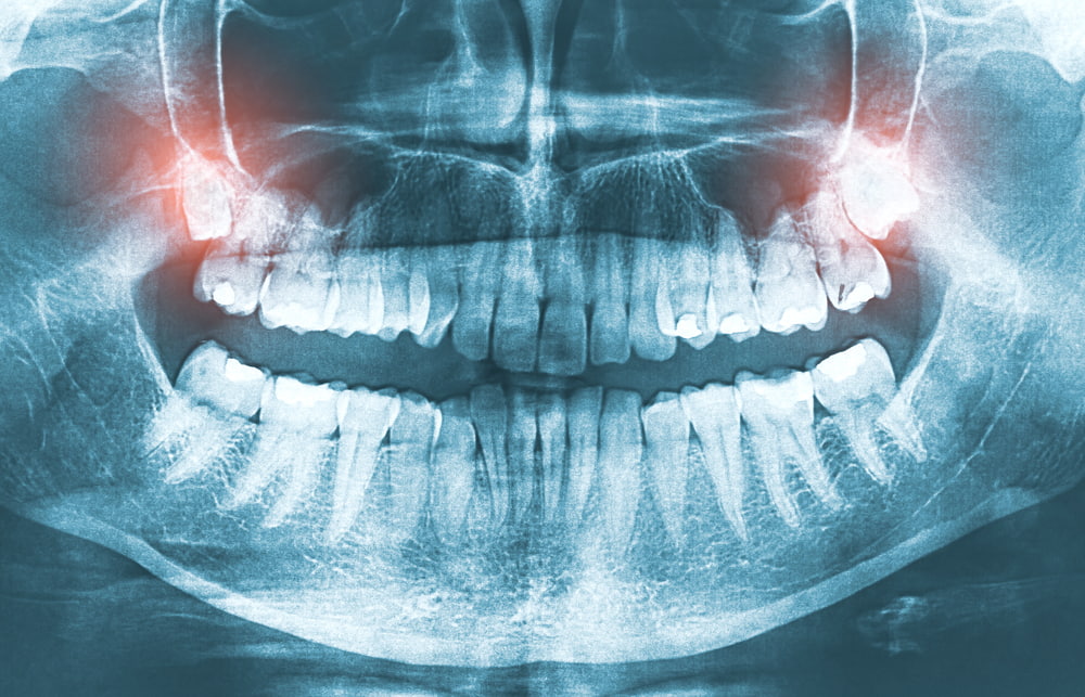 Where in Escondido can I get a safe impacted wisdom teeth removal