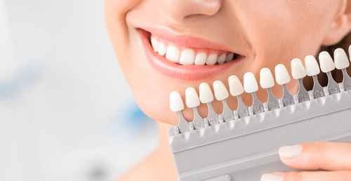 Do dental implants match your teeth