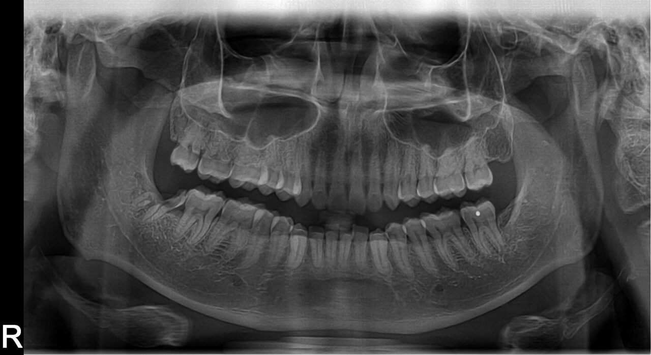 can wisdom teeth removals cause nerve damage