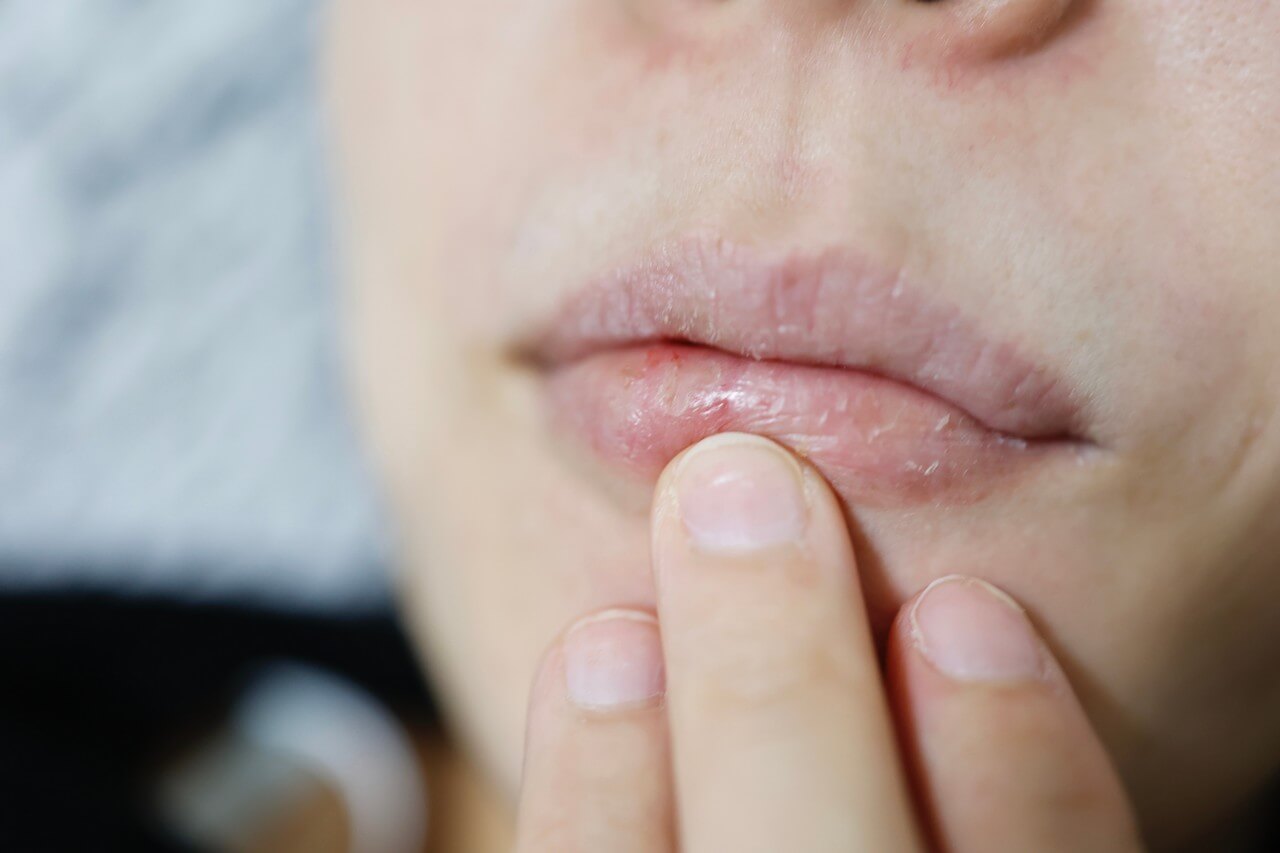 prolonged numbness after wisdom teeth removal