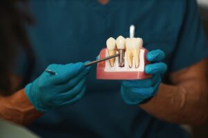 All-on-4 dental implants