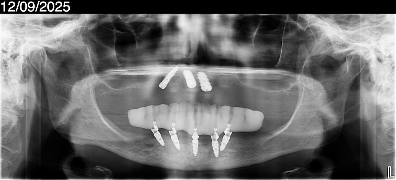 All-on-6 dental implants