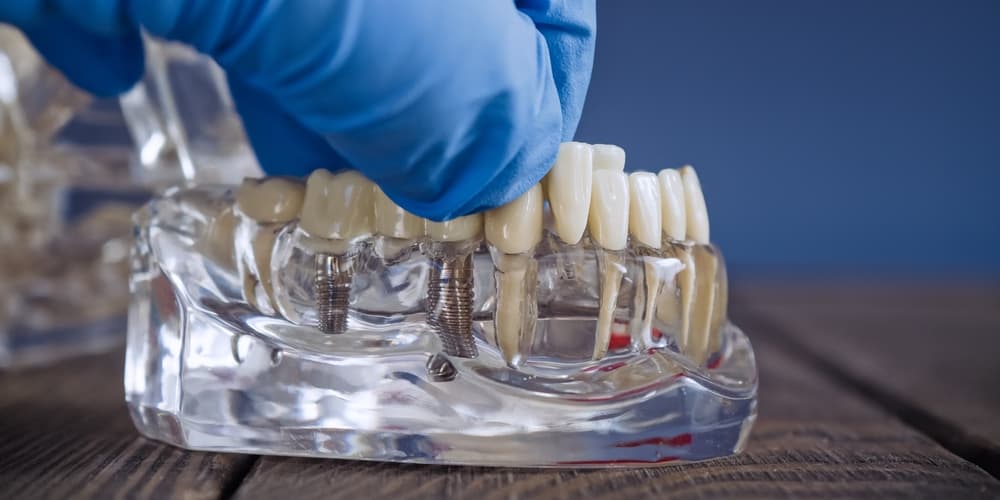 cantilever on all-on-4 bridge