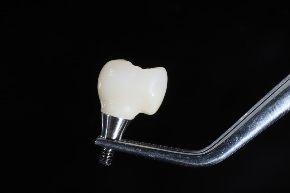 Can a loose dental implant be saved