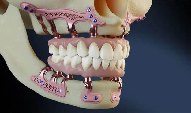 How does 3D printing improve the subperiosteal implant process