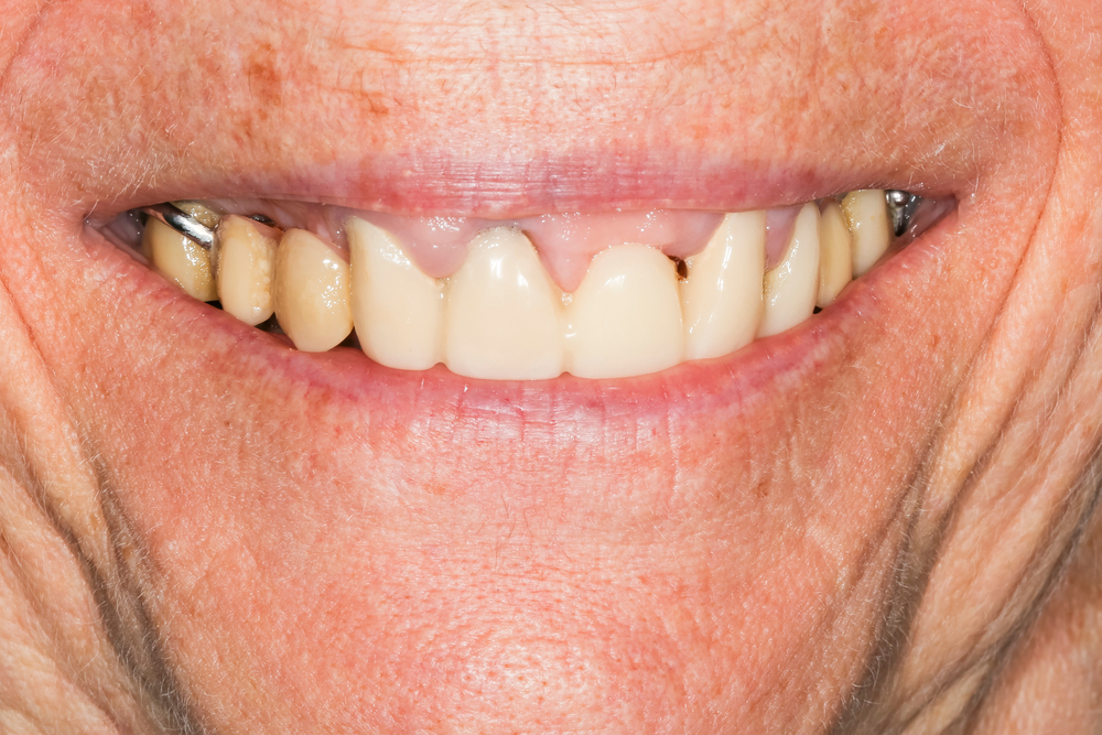 What is peri implantitis