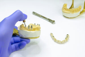 Is it worth getting All-on-4 dental implants