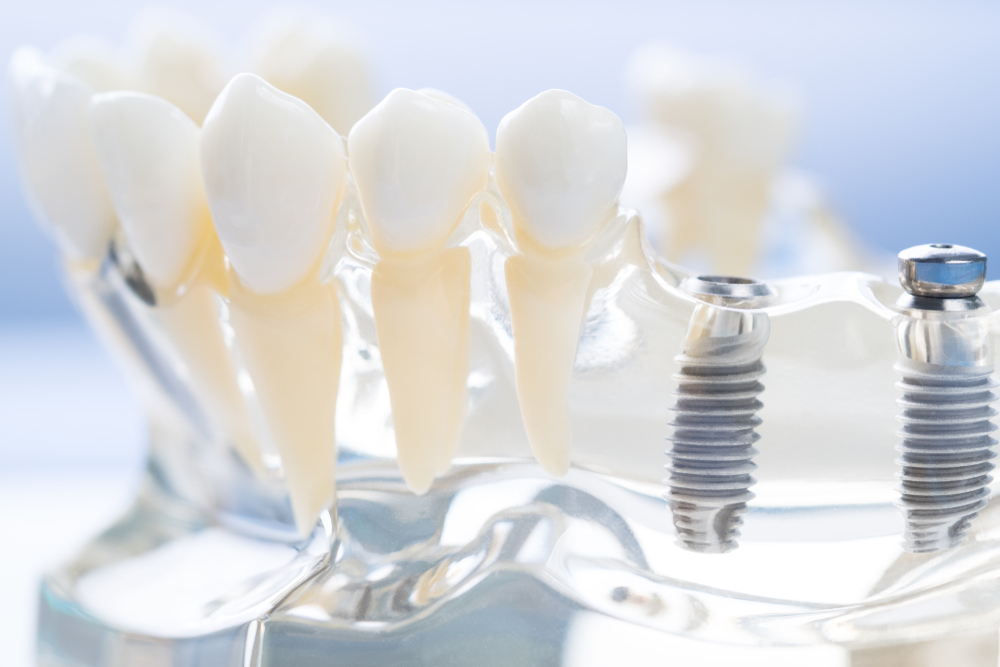 natural-looking All-on-4 dentures in Murrieta