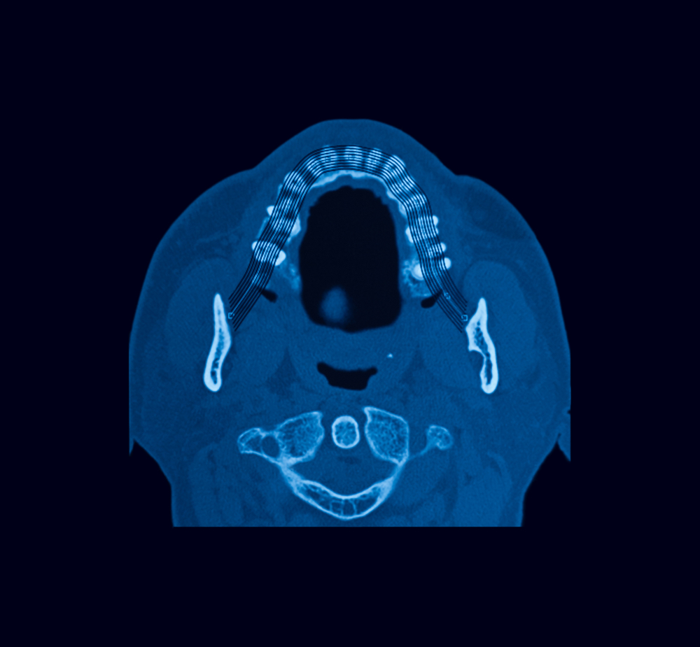 Can active gum disease delay treatment